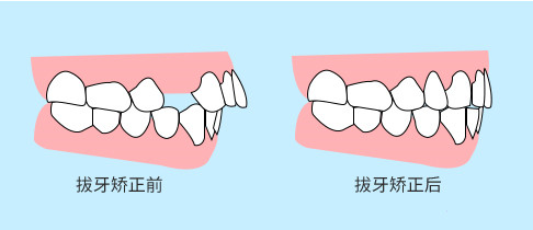 牙齒矯正前后對比圖